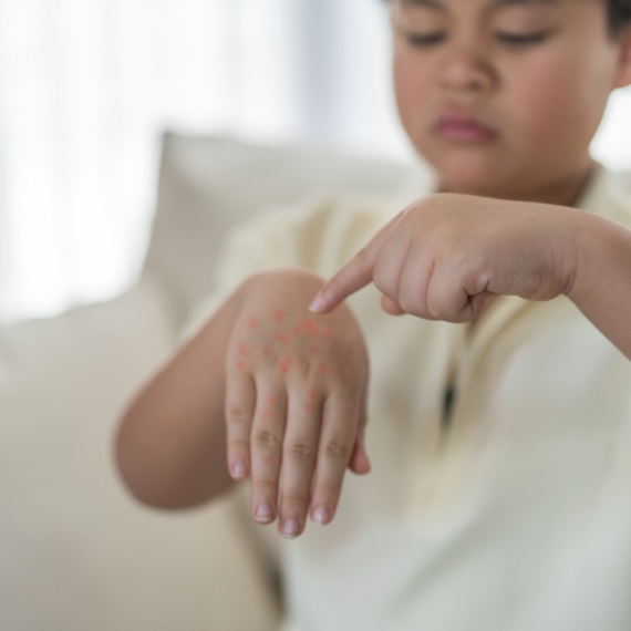 RODITELJI SE ČESTO ZBUNE: Doktor otkriva KAKO RAZLIKOVATI koksaki virus od ovčijih boginja kog dece