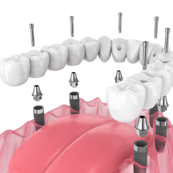 Koliko koštaju zubni implanti? Vodič kroz cenu, kvalitet i procedure