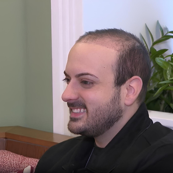 Pevač zbog PROBLEMA SA OPADANJEM KOSE otišao na TRANSPLANTACIJU, a sada se pohvalio PRVIM REZULTATIMA!