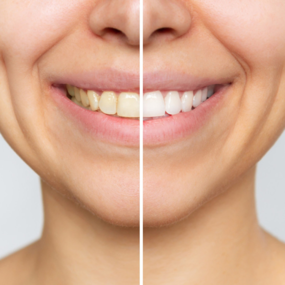 Stomatolzi dele 6 svakodnevnih GREŠAKA koje ljudi prave, a koje dovode do ŽUTIH ZUBA