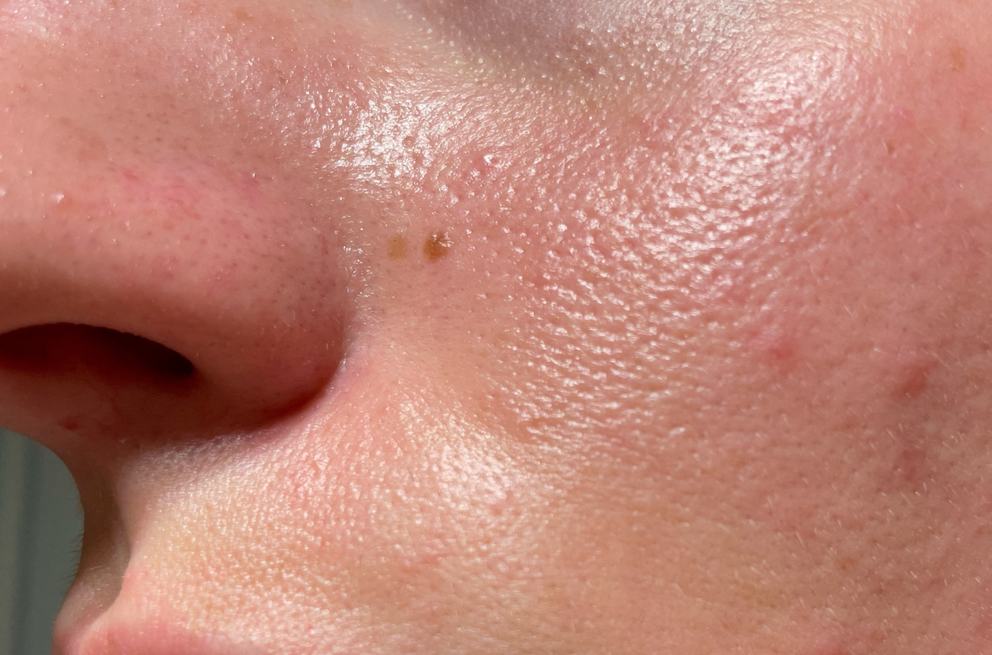 Muči vas masna koža? Evo kako pravilno da je negujete