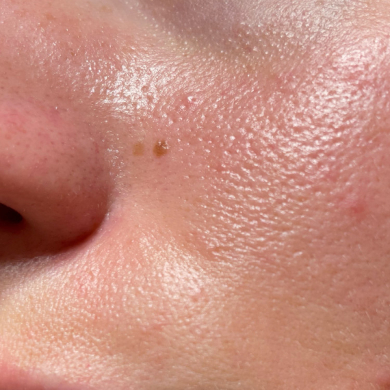 Muči vas masna koža? Evo kako pravilno da je negujete