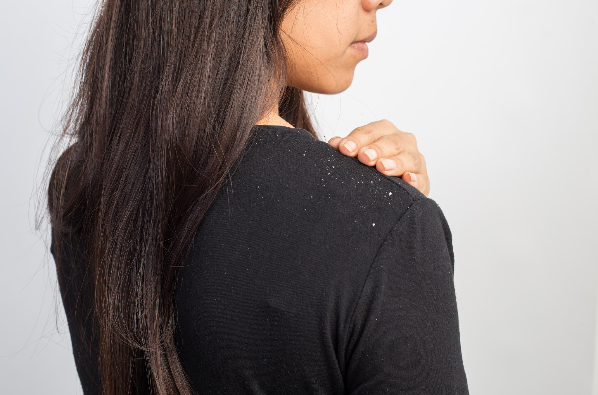 Šta izaziva perut i da li se može TRAJNO REŠITI? Dermatovenerolog daje KLJUČNE SAVETE
