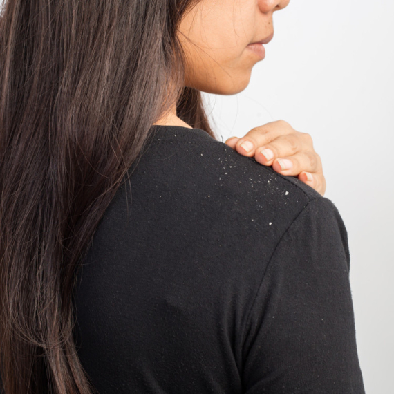 Šta izaziva perut i da li se može TRAJNO REŠITI? Dermatovenerolog daje KLJUČNE SAVETE