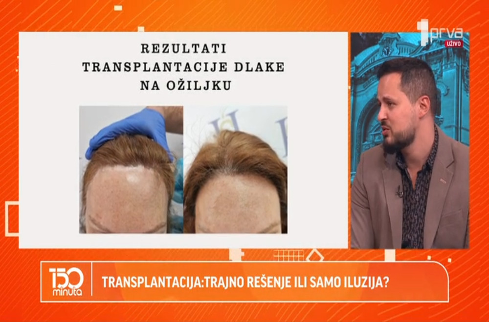 Da li transplantacija kose može biti trajno rešenje ili je samo privremena pomoć?
