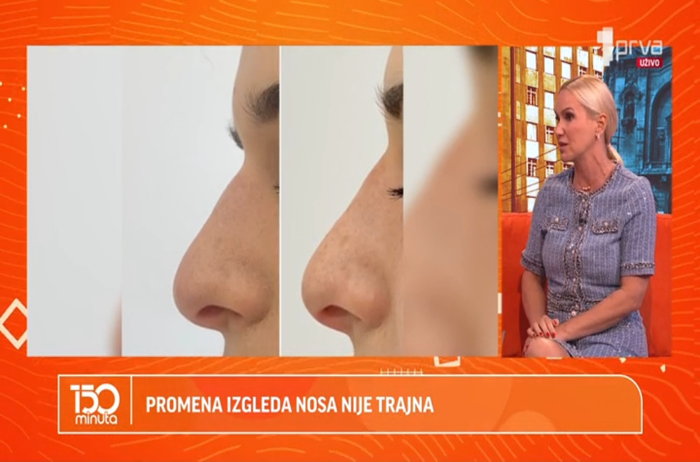 Da li ste čuli za nehirurško ispravljanje nosa?