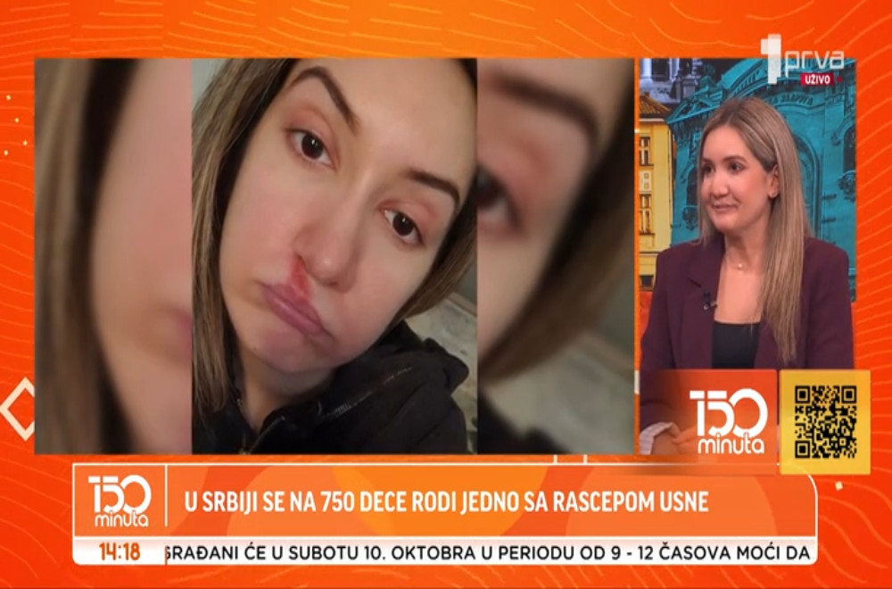 „Nikad neće biti lepa“: Odrastanje sa rascepom usne i predrasudama